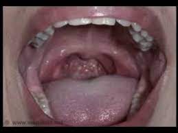 Back to top white or red patches in the mouth or throat Throat Cancer Symptoms In Tamil Language Celine Dion Songs Age