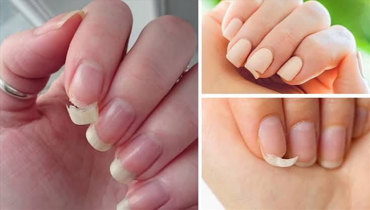 Nguyên nhân khiến móng tay giòn dễ gãy và cách khắc phục