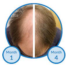 19 a single randomized controlled study in the current literature assessed the effects of azelaic acid on hair growth in patchy androgenetic alopecia (aga), where anthralin was set as the. Minoxidil Proven For Hair Loss