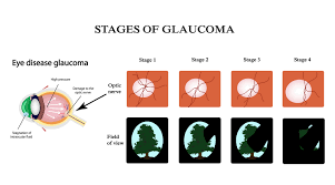 European glaucoma society, 4th ed. Can You Prevent Glaucoma