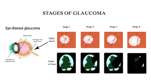 Brighter and clearer sight, increased visual contrast, bigger visual field Can You Prevent Glaucoma