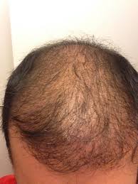 Do not prescribe to women and that you have to find the cause of the original hair loss issue indicating the importance of seeing an endocrinolgist. Could Minoxidil 5 Be Causing Extreme Hair Shedding 7 Months After Fue Hair Transplant Photo