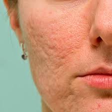 Aknenarben Entfernen Lasern Microneedling Bei Aknenarben The Bodyclinic Zurich