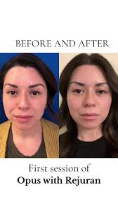 Amazing resuls after one single treatment with Opus and Rejuran. What  changes do you see in her skin? #opusplasma #opus #aesthetics  #skincareroutine #skin #rejuran #skinrejuvenation ...
