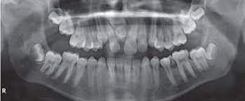 Russell, bsc, dds, msc • • magdalena a. Supernumerary Tooth In Premaxilla Mesiodens Download Scientific Diagram