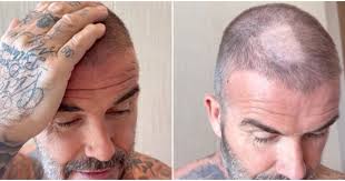 “Stai malissimo, ma che hai combinato in testa?”: incidente casalingo per  David Beckham. La moglie Victoria infierisce