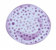 Leukozyten Zu Hoch Leukozytose