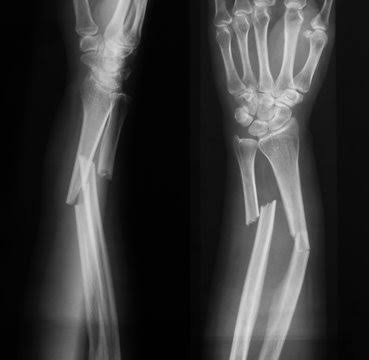 How Long Do Broken Bones Take to Heal