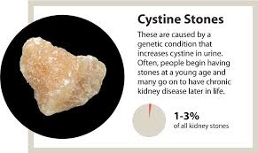 Kidney Stones A Marker Of Overall Kidney Health News Uab