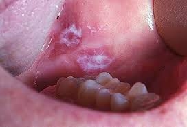 Image result for gum cancer symptoms