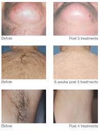 After laser, you should wait ideally 10 days until you can shave. Laser Hair Removal Treatment At Faces Med Spa In Maryland