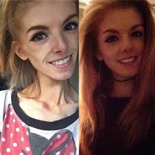 This young woman only ate one piece of bread a day for 5 years. Now grab a  tissue before you see her today Cоntinuеd reading the first comment 👇🏼👇🏼