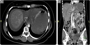 An Enigmatic Case Presentation Of Budd Chiari Syndrome With Pulmonary Embolism An Unusual Syndrome With An Uncommon Complication Sciencedirect