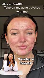 Audrey Tillinger Acne