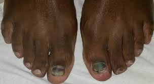 Image result for black toe diabetes