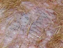 Hydrogen peroxide (hp) can kill molds such as powdery mildew caused by any number of fungi. 25 Awesome Does Hydrogen Peroxide Kill Demodex Mites Demodectic Mange