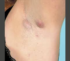 The odor is a result of bacterial growth. Hidradenitis Suppurativa Hs Symptoms Severity