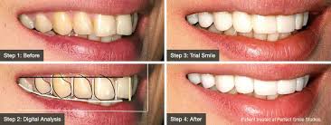 We did not find results for: Temporary Veneers Trial Smiles The Perfect Smile Studios