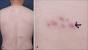 Herpes African American Pictures