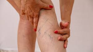 Varicose Veins: what they are, causes, symptoms and treatments