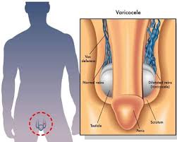 Image result for Varicocele