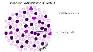 Chronic Lymphocytic Leukemia (CLL ...