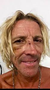 I nearly went blind from a nasty surfing injury, in Sri Lanka, where I  snapped my nose & a board went thru my cheek bone. , After recovering from  the injury I was back in the water after a few weeks ...