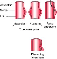 Fusiform Aneurysm Definition Of Fusiform Aneurysm By Medical Dictionary Abdominal Aortic Aneurysm Aneurysm Aortic Aneurysm