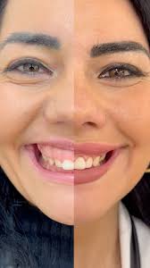 VERTICAL LIPS AND HYDRAFACIAL. Risultato ottenuto dopo la seconda seduta di  filler effettuata a 12 mesi dal primo trattamento.  @jaquelinecampese_nails_pmu #drpapapicco #medicinaestetica #lips #natural  #puglia