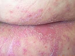 Image result for Candidiasis under breasts