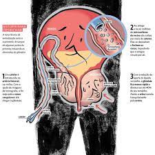 Novo Tratamento Para Hiperplasia O Aumento Da Prostata Saude E Vital Tratamento Saude