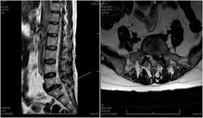 Length Of Stay Costs And Complications In Lumbar Disc Herniation Surgery By Standard Plif Versus A New Dynamic Interspinous Stabilization Technique Springerlink