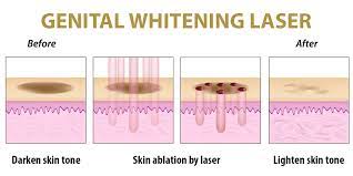 Homemade products are perfect to lighten your skin. Genital Skin Whitening Whitening Laser