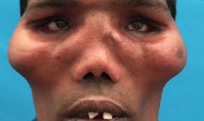 Man With Lion Face Has Bones Rebuilt By Surgeons To Look Unrecognisable World News Express Co Uk