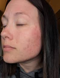 Has Anyone Ever cut out gluten and felt better?