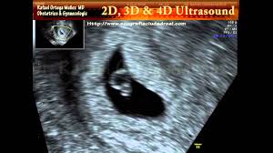 Ty nastanou až v pokročilejším stádiu těhotenství. 5 Tyzden Tehotenstva Najmama Sk