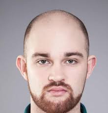 No matter how luscious your locks have seemingly always been, at one point or another, that volume will lessen (for some more than others). Going Going Gone I Started Losing My Hair At 16 Men S Hair The Guardian
