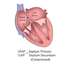 Image result for Delayed Transition from Fetal Circulation