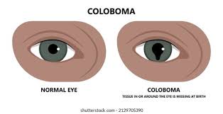 Image result for Coloboma