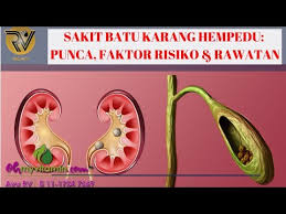 Rawatan batu karang dan batu hempedu. Sakit Batu Karang Hempedu Apa Punca Faktor Risiko Cara Atasi Rawatan Sakit Batu Karang Hempedu Youtube