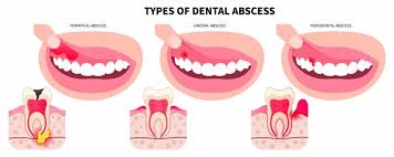 Image result for Periodontal Abscess