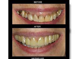 Pin On Full Mouth Reconstruction Gallery