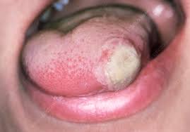 Image result for mouth ulcer on tongue)