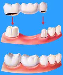 Puente Fijo K F Dental Spa Recuerda Que La Limpieza Dental Es Dos Veces Al Ano Agenda Tu Cita Hoy 664 6 Dental Bridge Dental Crowns Dental Treatment