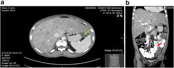 Acute Liver Failure As The First Feature Of Systemic Lupus Erythematosus Springerlink