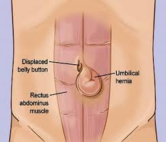 An Umbilical Hernia Occurs When Part Of The Intestine Protrudes Through The