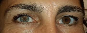 Et des taches jaunes sont apparues ! Iris Et Couleur Des Yeux Docteur Damien Gatinel