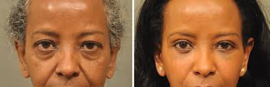 Pin On Changes Under Eye Treatments