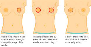 This procedure may leave a small scar around the areola. Areola Reduction Surgery In Boca Raton At Ennis Plastic Surgery