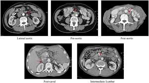 Specific medical conditions affect these structures with distinctive consistency and location. Para Aortic Lymph Node Metastasis In Lower Thoracic Esophageal Squamous Cell Carcinoma After Radical Esophagectomy A Ct Based Atlas And Its Clinical Implications For Adjuvant Radiotherapy